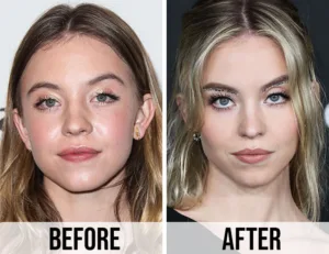 Sydney Sweeney before and after surgery
