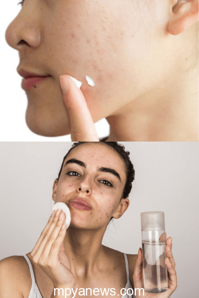 Best skincare routines for oily skin with acne: cute skin