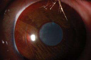 Contact Lens II: Specialty Practice Past Paper Exam